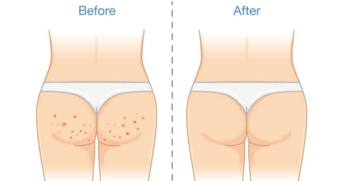 Common Causes of Butt Acne